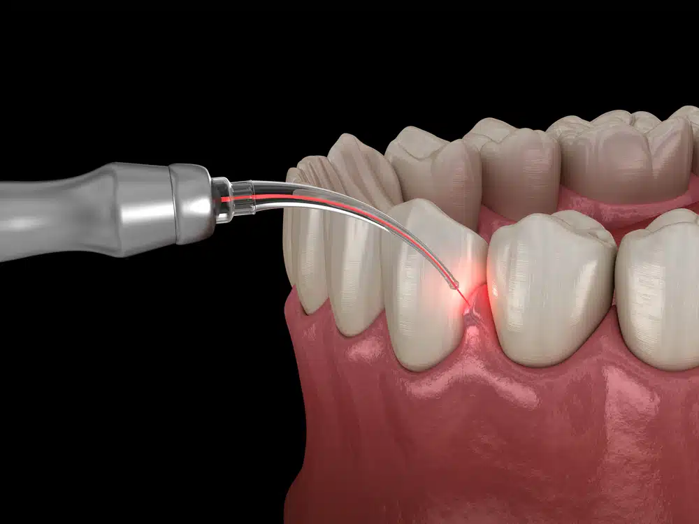 Gum,Correction,Surgery,With,Laser.,Medically,Accurate,Tooth,3d,Illustration